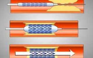 Лечение атеросклероза аорты сердца — эффективные методы