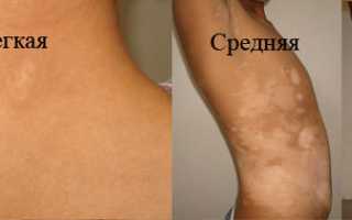 Пятна Витилиго — Как убрать? — Причины
