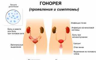 Гонорея у женщин — симптомы и признаки