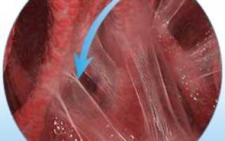 Спайки легких — причины, симптомы и лечение