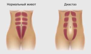 Тянущие боли внизу живота на 5 неделе беременности — что это значит?
