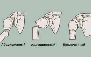 Абдукционный перелом хирургической шейки плеча — причины, симптомы и лечение