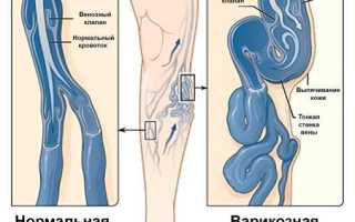 Отсутствие вен у человека — причины и последствия