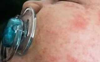 Золотистый стафилококк у детей — признаки и симптомы