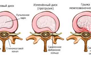 Пролабирование диска — причины, симптомы и лечение