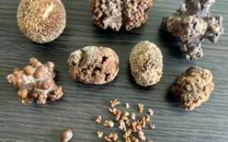 Как узнать какой камень в почке