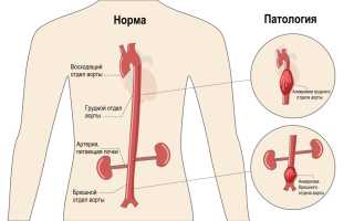 Обызвествление брюшной аорты — что это такое?