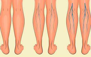 Тромбоз суральных вен — причины, симптомы и лечение