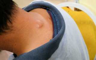 Вырезаем жировик самостоятельно — пошаговая инструкция