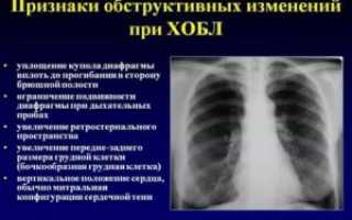 Рентген признаки бронхита