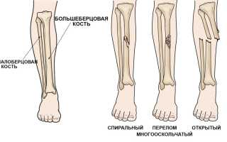 Перелом костей голени — причины, симптомы и лечение