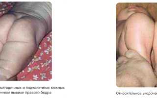 Симптом Эрлахера — Что Это Такое и Как Его Распознать