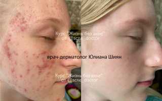 Что не следует делать при проблемной коже? -Топ-5 нюансов