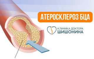 Эхо признаки нестенозирующего атеросклероза — что нужно знать