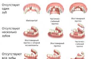 Какие бывают зубные протезы — Какой выбрать?