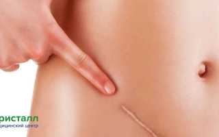 Когда можно пить после удаления аппендицита