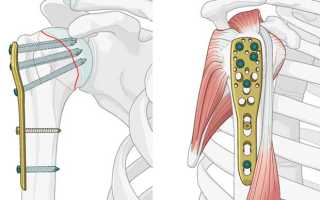 Хирургическое лечение перелома шейки плеча
