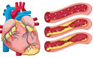 Атеросклероз коронарных артерий — причины, симптомы и лечение
