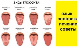Глосситом — причины, симптомы и лечение