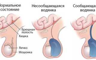 Водянка — основные симптомы и признаки заболевания