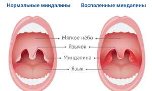 Всё о миндалинах — симптомы, лечение и профилактика