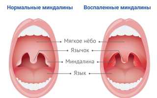 Всё о миндалинах — симптомы, лечение и профилактика