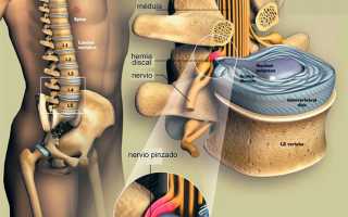 Греет ли грыжа поясничного отдела — правда и мифы