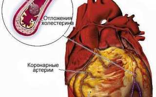 Отмирание сердечной мышцы — причины и последствия