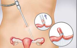 Стерилизация по Мадленеру — Эффективность и Преимущества
