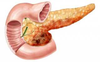 Полип поджелудочной железы — диагностика на УЗИ