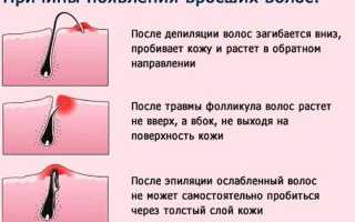 Психосоматика и вросшие волосы — скрытая связь