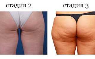 Что категорически нельзя делать при целлюлите