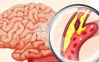 Атеросклероз магистральных артерий головного мозга — причины, симптомы и лечение