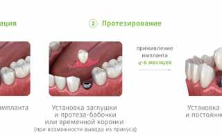 Почему имплант быстрее приживается при установке в нижнюю челюсть, чем в верхнюю?