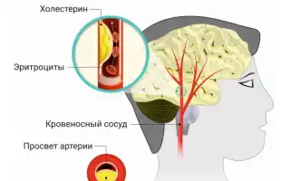 Стенозирующий атеросклероз артерий — причины, симптомы и лечение