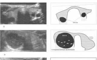 Изоэхогенная структура щитовидной железы — что это значит?