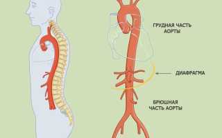 Атеросклероз брюшного отдела аорты — симптомы и лечение