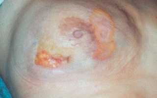 Гранулема молочной железы — причины, симптомы и лечение