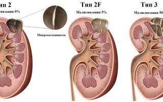 Bosniak классификация