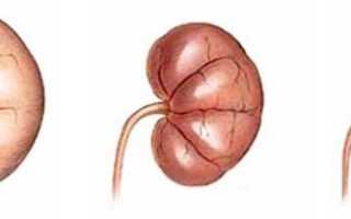Сморщивание почки что это такое