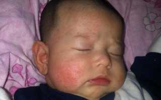 Лечение диатеза у новорожденных при грудном вскармливании