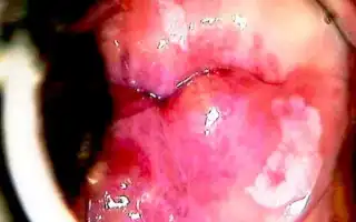 Лейкоплакия с очаговым койлоцитозом — причины, симптомы и лечение