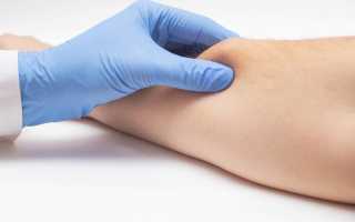 Быстрое и простое избавление от жировика на руке в домашних условиях