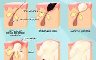 Черные точки — Причины — Способы избавиться