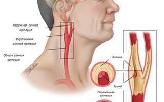 Нестенозирующий атеросклероз — что это такое?