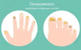Быстрое и эффективное лечение грибка ногтей на ногах дома