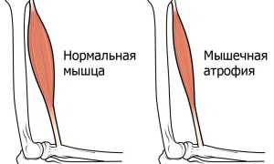 Усыхание ноги — причины и эффективные методы лечения