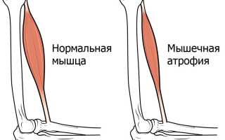 Усыхание ноги — причины и эффективные методы лечения