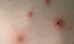 Гнойные прыщи при ветрянке у взрослых — причины и лечение