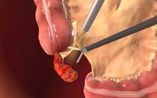 Купание после удаления аппендицита — когда можно и как правильно